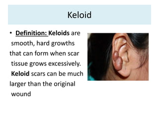 Keloid
• Definition: Keloids are
smooth, hard growths
that can form when scar
tissue grows excessively.
Keloid scars can be much
larger than the original
wound
 