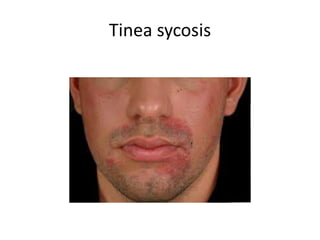 Tinea sycosis
 
