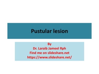 Pustular lesion
By
Dr. Laraib Jameel Rph
Find me on slideshare.net
https://www.slideshare.net/
 