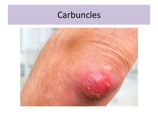 Pustular lesions | PPTX