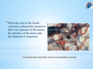 4 th ventricle- Anatomical and surgical perspective | PPTX