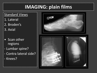 Calcaneal fractures | PPTX