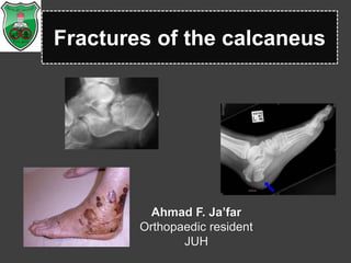 Fractures of the calcaneus
Ahmad F. Ja’far
Orthopaedic resident
JUH
 