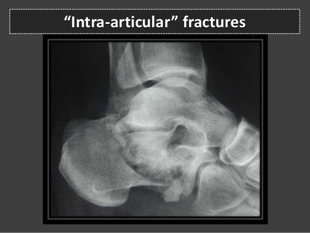 calcaneal fractures calcaneal fracture