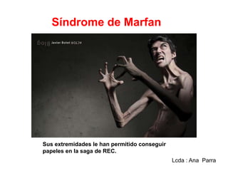 Síndrome de Marfan

Sus extremidades le han permitido conseguir
papeles en la saga de REC.
Lcda : Ana Parra

 