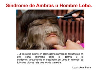 Síndrome de Ambras u Hombre Lobo.

. El trastorno ocurre en cromosoma número 8, resultantes en
una
seria
anomalía
entre
la
dermis
y
la
epidermis, provocando el desarrollo de unos 5 millones de
folículos pilosos más que los de la media.
Lcda : Ana Parra

 
