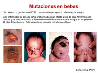 Mutaciones en bebes
Se debe a un gen llamado SOX2, causante de que algunos bebés nazcan sin ojos
Esta enfermedad se conoce como anoftalmia bilateral, afecta a uno de cada 100.000 recién
nacidos y se produce cuando el feto no desarrolla de manera normal los ojos en los primeros
28 días del embarazo. Esta Mutación es causada por fallos genéticos.

Lcda : Ana Parra

 