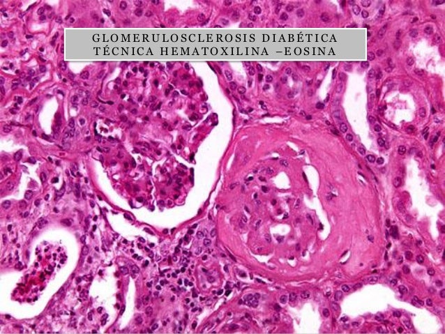 diabetes glomeruloesclerosis patología diabetes glomeruloesclerosis patología