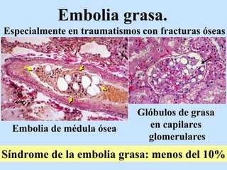 Embolia grasa.
Especialmente en traumatismos con fracturas óseas
Embolia de médula ósea
Glóbulos de grasa
en capilares
glomerulares
Síndrome de la embolia grasa: menos del 10%
 