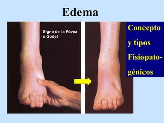 Edema
Concepto
y tipos
Fisiopato-
génicos
Signo de la Fóvea
o Godet
 