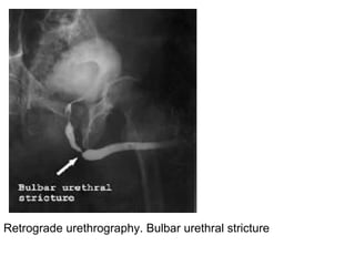 Retrograde urethrography. Bulbar urethral stricture
 