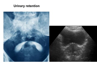 Urinary retention
 