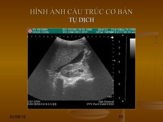 01/06/15 10
HÌNH ẢNH CẤU TRÚC CƠ BẢNHÌNH ẢNH CẤU TRÚC CƠ BẢN
TỤ DỊCHTỤ DỊCH
 