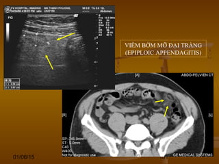 01/06/15 101
VIÊM BỜM MỠ ĐẠI TRÀNG
(EPIPLOIC APPENDAGITIS)
 