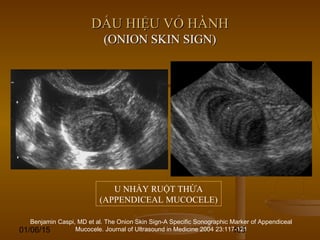 01/06/15 105
DẤU HIỆU VỎ HÀNHDẤU HIỆU VỎ HÀNH
(ONION SKIN SIGN)(ONION SKIN SIGN)
Benjamin Caspi, MD et al. The Onion Skin Sign-A Specific Sonographic Marker of Appendiceal
Mucocele. Journal of Ultrasound in Medicine 2004 23:117-121
U NHẦY RUỘT THỪA
(APPENDICEAL MUCOCELE)
 