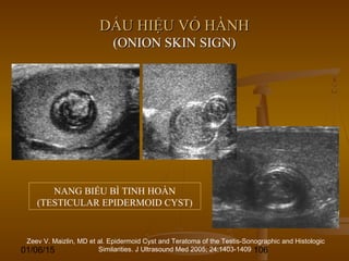 01/06/15 106
DẤU HIỆU VỎ HÀNHDẤU HIỆU VỎ HÀNH
(ONION SKIN SIGN)(ONION SKIN SIGN)
Zeev V. Maizlin, MD et al. Epidermoid Cyst and Teratoma of the Testis-Sonographic and Histologic
Similarities. J Ultrasound Med 2005; 24:1403-1409
NANG BIỂU BÌ TINH HOÀN
(TESTICULAR EPIDERMOID CYST)
 