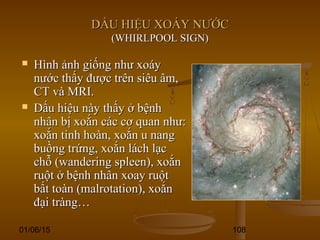 01/06/15 108
DẤU HIỆU XOÁY NƯỚCDẤU HIỆU XOÁY NƯỚC
(WHIRLPOOL SIGN)(WHIRLPOOL SIGN)
 Hình ảnh giống như xoáyHình ảnh giống như xoáy
nước thấy được trên siêu âm,nước thấy được trên siêu âm,
CT và MRI.CT và MRI.
 Dấu hiệu này thấy ở bệnhDấu hiệu này thấy ở bệnh
nhân bị xoắn các cơ quan như:nhân bị xoắn các cơ quan như:
xoắn tinh hoàn, xoắn u nangxoắn tinh hoàn, xoắn u nang
buồng trứng, xoắn lách lạcbuồng trứng, xoắn lách lạc
chỗ (wandering spleen), xoắnchỗ (wandering spleen), xoắn
ruột ở bệnh nhân xoay ruộtruột ở bệnh nhân xoay ruột
bất toàn (malrotation), xoắnbất toàn (malrotation), xoắn
đại tràng…đại tràng…
 