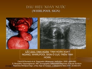 01/06/15 109
DẤU HIỆU XOÁY NƯỚCDẤU HIỆU XOÁY NƯỚC
(WHIRLPOOL SIGN)(WHIRLPOOL SIGN)
CẮT DỌC TINH HOÀN: TINH HOÀN XOAY
NGANG, WHIRLPOOL SIGN Ở CỰC TRÊN TINH
HOÀN.
Carol.M.Rumack et al. Diagnostic Ultrasound. 3rdEdition. 2005. p849-883
S. Boopathy Vijayaraghavan, MD. Sonographic Differential Diagnosis of Acute Scrotum
Real-time Whirlpool Sign, a Key Sign of Torsion. J Ultrasound Med 2006; 25:563-574
 