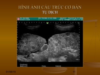 01/06/15 11
HÌNH ẢNH CẤU TRÚC CƠ BẢNHÌNH ẢNH CẤU TRÚC CƠ BẢN
TỤ DỊCHTỤ DỊCH
 