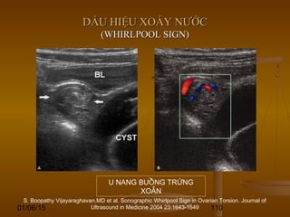 01/06/15 110
DẤU HIỆU XOÁY NƯỚCDẤU HIỆU XOÁY NƯỚC
(WHIRLPOOL SIGN)(WHIRLPOOL SIGN)
U NANG BUỒNG TRỨNG
XOẮN
S. Boopathy Vijayaraghavan,MD et al. Sonographic Whirlpool Sign in Ovarian Torsion. Journal of
Ultrasound in Medicine 2004 23:1643-1649
 