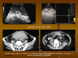 01/06/15 111
XOẮN LÁCH LẠC CHỖ
Cengiz Yinmaz, MD et al. Torsion of a Wandering Spleen Associated With Portal Vein Thrombosis. J
Ultrasound Med 2005; 24:379-382
 