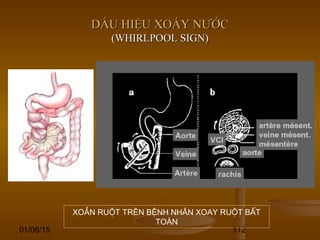 01/06/15 112
DẤU HIỆU XOÁY NƯỚCDẤU HIỆU XOÁY NƯỚC
(WHIRLPOOL SIGN)(WHIRLPOOL SIGN)
XOẮN RUỘT TRÊN BỆNH NHÂN XOAY RUỘT BẤT
TOÀN
 