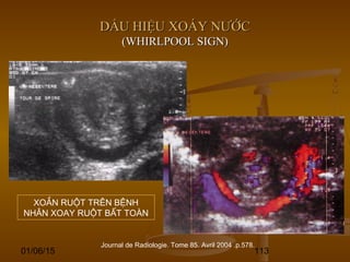 01/06/15 113
DẤU HIỆU XOÁY NƯỚCDẤU HIỆU XOÁY NƯỚC
(WHIRLPOOL SIGN)(WHIRLPOOL SIGN)
Journal de Radiologie. Tome 85. Avril 2004 .p.578.
XOẮN RUỘT TRÊN BỆNH
NHÂN XOAY RUỘT BẤT TOÀN
 