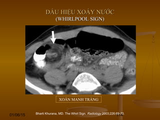 01/06/15 114
DẤU HIỆU XOÁY NƯỚCDẤU HIỆU XOÁY NƯỚC
(WHIRLPOOL SIGN)(WHIRLPOOL SIGN)
XOẮN MANH TRÀNG
Bharti Khurana, MD. The Whirl Sign. Radiology 2003;226:69-70.
 