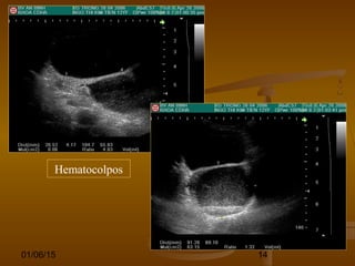 01/06/15 14
Hematocolpos
 