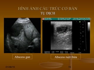 01/06/15 15
HÌNH ẢNH CẤU TRÚC CƠ BẢNHÌNH ẢNH CẤU TRÚC CƠ BẢN
TỤ DỊCHTỤ DỊCH
Abscess ruột thừaAbscess gan
 