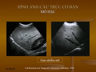 01/06/15 20
HÌNH ẢNH CẤU TRÚC CƠ BẢNHÌNH ẢNH CẤU TRÚC CƠ BẢN
MÔ ĐẶCMÔ ĐẶC
C.M.Rumack et al. Diagnostic Ultrasound. 3rdEdition. 2005
Gan nhiễm mỡ
 