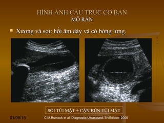 01/06/15 28
HÌNH ẢNH CẤU TRÚC CƠ BẢNHÌNH ẢNH CẤU TRÚC CƠ BẢN
MÔ RẮNMÔ RẮN
 Xương và sỏi: hồi âm dày và có bóng lưng.Xương và sỏi: hồi âm dày và có bóng lưng.
SỎI TÚI MẬT + CẶN BÙN TÚI MẬT
C.M.Rumack et al. Diagnostic Ultrasound. 3rdEdition. 2005
 
