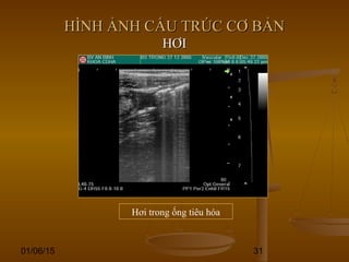 01/06/15 31
HÌNH ẢNH CẤU TRÚC CƠ BẢNHÌNH ẢNH CẤU TRÚC CƠ BẢN
HƠIHƠI
Hơi trong ống tiêu hóa
 