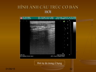 01/06/15 32
Hơi tự do trong ổ bụng
HÌNH ẢNH CẤU TRÚC CƠ BẢNHÌNH ẢNH CẤU TRÚC CƠ BẢN
HƠIHƠI
 