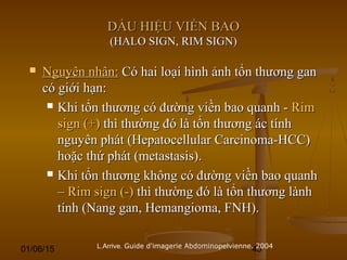 01/06/15 45
DẤU HIỆU VIỀN BAODẤU HIỆU VIỀN BAO
(HALO SIGN, RIM SIGN)(HALO SIGN, RIM SIGN)
 Nguyên nhân:Nguyên nhân: Có hai loại hình ảnh tổn thương ganCó hai loại hình ảnh tổn thương gan
có giới hạn:có giới hạn:
 Khi tổn thương có đường viền bao quanh -Khi tổn thương có đường viền bao quanh - RimRim
sign (+)sign (+) thì thường đó là tổn thương ác tínhthì thường đó là tổn thương ác tính
nguyên phát (Hepatocellular Carcinoma-HCC)nguyên phát (Hepatocellular Carcinoma-HCC)
hoặc thứ phát (metastasis).hoặc thứ phát (metastasis).
 Khi tổn thương không có đường viền bao quanhKhi tổn thương không có đường viền bao quanh
–– Rim sign (-)Rim sign (-) thì thường đó là tổn thương lànhthì thường đó là tổn thương lành
tính (Nang gan, Hemangioma, FNH).tính (Nang gan, Hemangioma, FNH).
L.Arrive. Guide d'imagerie Abdominopelvienne. 2004
 