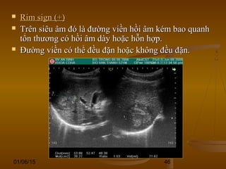01/06/15 46
 Rim sign (+)Rim sign (+)
 Trên siêu âm đó là đường viền hồi âm kém bao quanhTrên siêu âm đó là đường viền hồi âm kém bao quanh
tổn thương có hồi âm dày hoặc hỗn hợp.tổn thương có hồi âm dày hoặc hỗn hợp.
 Đường viền có thể đều đặn hoặc không đều đặn.Đường viền có thể đều đặn hoặc không đều đặn.
 