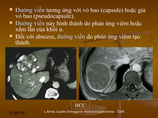 01/06/15 47
 Đường viềnĐường viền tương ứng với vỏ bao (capsule) hoặc giả
vỏ bao (pseudocapsule).
 Đường viềnĐường viền này hình thành do phản ứng viêm hoặc
xâm lấn của khối u.
 Đối với abscess, đường viềnđường viền do phản ứng viêm tạo
thành.
L.Arrive. Guide d'imagerie Abdominopelvienne. 2004
HCC
 