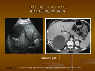 01/06/15 48
DẤU HIỆU VIỀN BAODẤU HIỆU VIỀN BAO
(HALO SIGN, RIM SIGN)(HALO SIGN, RIM SIGN)
Abscess gan
Joseph K.T.Lee. Lee computed body tomography with MRI correlation. 1998.
 