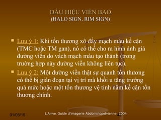 01/06/15 49
DẤU HIỆU VIỀN BAODẤU HIỆU VIỀN BAO
(HALO SIGN, RIM SIGN)(HALO SIGN, RIM SIGN)
 Lưu ý 1: Khi tổn thương xô đẩy mạch máu kề cận
(TMC hoặc TM gan), nó có thể cho ra hình ảnh giả
đường viền do vách mạch máu tạo thành (trong
trường hợp này đường viền không liên tục).
 Lưu ý 2: Một đường viền thật sự quanh tổn thương
có thể bị gián đoạn tại vị trí mà khối u tăng trưởng
quá mức hoặc một tổn thương vệ tinh nằm kế cận tổn
thương chính.
L.Arrive. Guide d'imagerie Abdominopelvienne. 2004
 