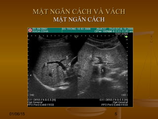 01/06/15 5
MẶT NGĂN CÁCH VÀ VÁCHMẶT NGĂN CÁCH VÀ VÁCH
MẶT NGĂN CÁCHMẶT NGĂN CÁCH
11
22
334455
66
77
88
 