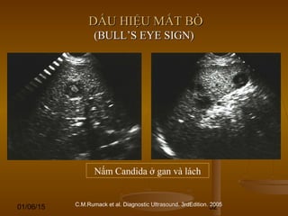 01/06/15 52
DẤU HIỆU MẮT BÒDẤU HIỆU MẮT BÒ
(BULL’S EYE SIGN)(BULL’S EYE SIGN)
Nấm Candida ở gan và lách
C.M.Rumack et al. Diagnostic Ultrasound. 3rdEdition. 2005
 