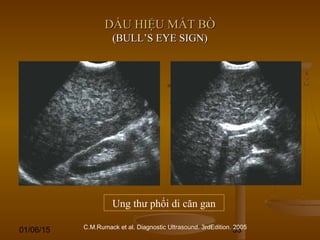 01/06/15 53
DẤU HIỆU MẮT BÒDẤU HIỆU MẮT BÒ
(BULL’S EYE SIGN)(BULL’S EYE SIGN)
Ung thư phổi di căn gan
C.M.Rumack et al. Diagnostic Ultrasound. 3rdEdition. 2005
 