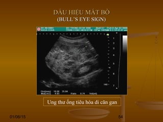 01/06/15 54
DẤU HIỆU MẮT BÒDẤU HIỆU MẮT BÒ
(BULL’S EYE SIGN)(BULL’S EYE SIGN)
Ung thư ống tiêu hóa di căn gan
 