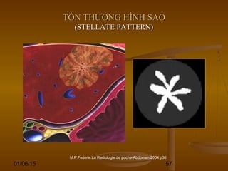 01/06/15 57
TỔN THƯƠNG HÌNH SAOTỔN THƯƠNG HÌNH SAO
(STELLATE PATTERN)(STELLATE PATTERN)
M.P.Federle.La Radiologie de poche-Abdomen.2004.p36
 