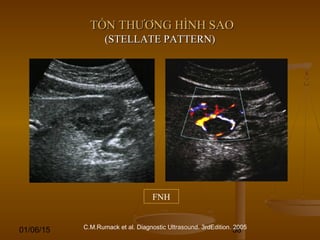 01/06/15 58
TỔN THƯƠNG HÌNH SAOTỔN THƯƠNG HÌNH SAO
(STELLATE PATTERN)(STELLATE PATTERN)
C.M.Rumack et al. Diagnostic Ultrasound. 3rdEdition. 2005
FNH
 