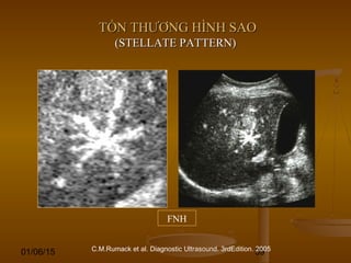 01/06/15 59
TỔN THƯƠNG HÌNH SAOTỔN THƯƠNG HÌNH SAO
(STELLATE PATTERN)(STELLATE PATTERN)
C.M.Rumack et al. Diagnostic Ultrasound. 3rdEdition. 2005
FNH
 
