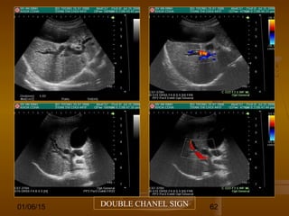 01/06/15 62DOUBLE CHANEL SIGN
 