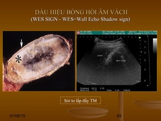 01/06/15 65
DẤU HIỆU BÓNG HỒI ÂM VÁCHDẤU HIỆU BÓNG HỒI ÂM VÁCH
(WES SIGN - WES=Wall Echo Shadow sign)(WES SIGN - WES=Wall Echo Shadow sign)
Sỏi to lấp đầy TM
 