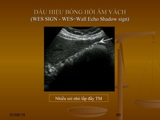 01/06/15 66
DẤU HIỆU BÓNG HỒI ÂM VÁCHDẤU HIỆU BÓNG HỒI ÂM VÁCH
(WES SIGN - WES=Wall Echo Shadow sign)(WES SIGN - WES=Wall Echo Shadow sign)
Nhiều sỏi nhỏ lấp đầy TM
 
