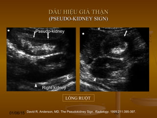 01/06/15 70
DẤU HIỆU GIẢ THẬNDẤU HIỆU GIẢ THẬN
(PSEUDO-KIDNEY SIGN)(PSEUDO-KIDNEY SIGN)
LỒNG RUỘT
Pseudo-kidneyPseudo-kidney
Right kidneyRight kidney
David R. Anderson, MD. The Pseudokidney Sign. Radiology. 1999;211:395-397.
 